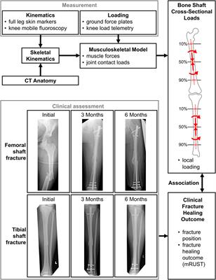 Lower-limb internal loading and potential consequences for fracture healing